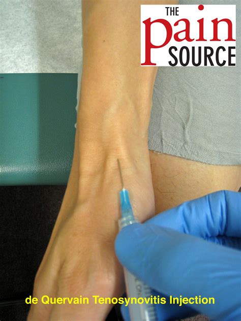Extensor Tendonitis Injection at Francis Needham blog