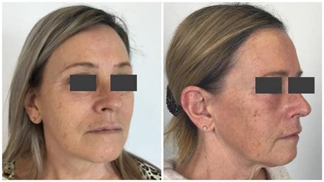 how much does fat transfer to face cost