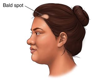 bald patch tu dien chi tiet va cach su dung