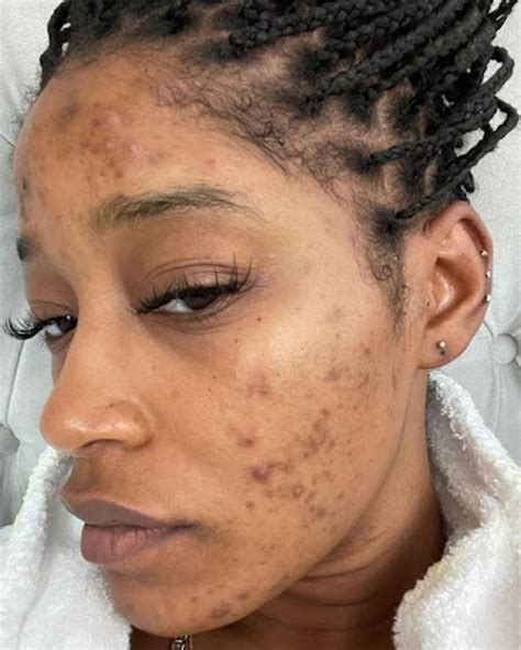 How To Get Rid of Acne Scars: Best Treatment Options & More – Zensa ...