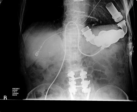 LEFT VENTRICULAR ASSIST DEVICE - Buyxraysonline