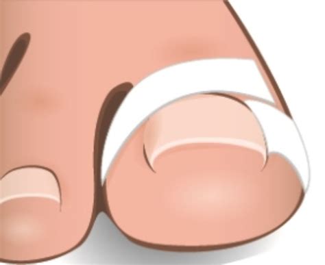 Ingrown Toenail Removal: Is It REALLY Painful? DIY or Doc?