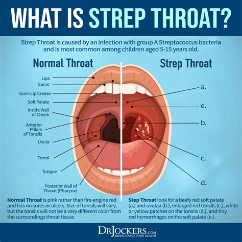 Strep Throat: Symptoms and 15 Natural Support Strategies