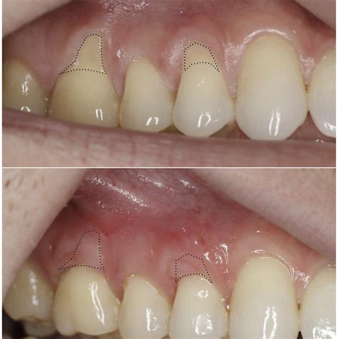 Soft Tissue Gum Graft | Before & After | Periodontist NYC