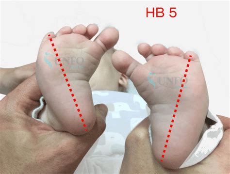 metatarsus adductus unfo med medical research  therapy