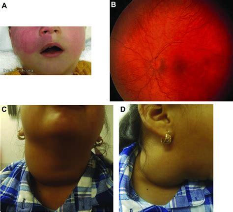 Capillary malformation (CM) and lymphatic malformation (LM). A and B ...