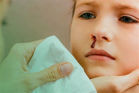 Coágulos De Sangue Saindo Do Nariz E Boca - Nariz sangrando: o que pode ser e como amenizar