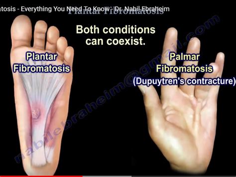 Foot Health Facts Plantar Fibroma at Rachel Fairweather blog