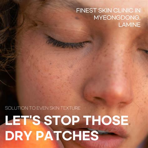 Let’s Stop Those Dry Patches – Korea Skin Clinic in Myeong-dong