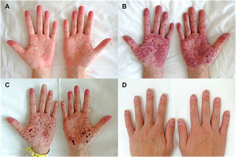 Adult Hand, Foot, and Mouth Disease - The American Journal of Medicine