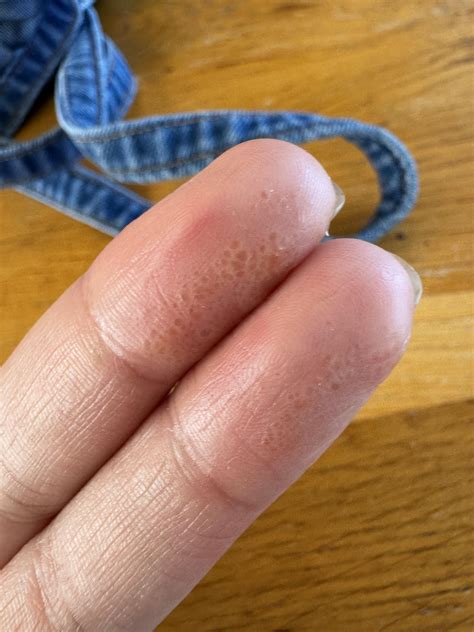 Weird blisters/spots on the side of my fingers : r/medical