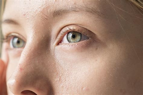 Olho De Pessoa Com Anemia - Cómo se ven los ojos de una persona con anemia