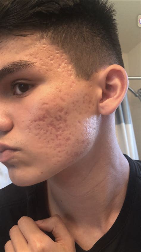 Severe acne scarring :( – Acne Scars – Acne.org Forum
