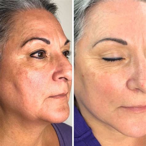 Procell Microchanneling - Elite Esthetics Gainesville FL