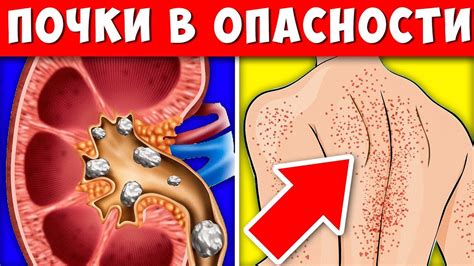 Серьёзные симптомы Проблем с Почками! + Чем вычистить Почки - YouTube