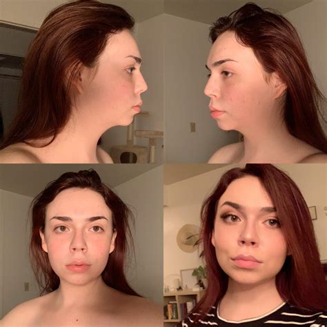I hate my profile and my face without makeup. What procedures would be