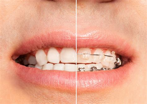 compare ceramic braces  clear aligners