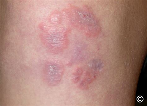 Erythema Elevatum Diutinum Pictures Erythema Elevatum Diutinum Bako