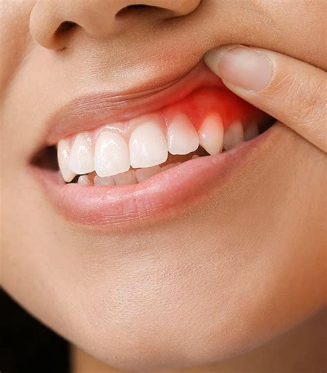 periodontal disease treatment huntsville al tyson dental