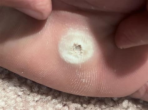 plantar wart  corn rwarts