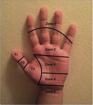 Flexor Tendon Zones Hand