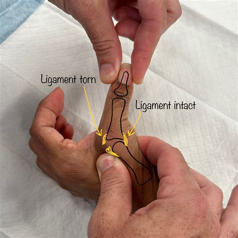Thumb Ulnar Collateral Ligament (UCL) Repair | Dr Oscar Brumby-Rendell
