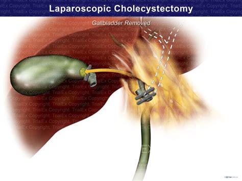 Removal of Gallbladder During Laparoscopic Cholecystectomy - Tria...