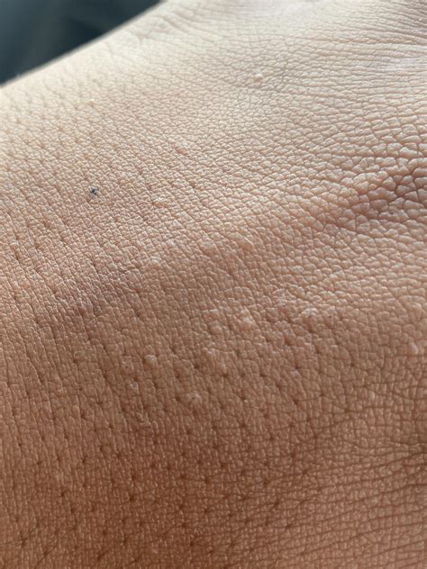 Weird bumps on my hands : r/medical_advice