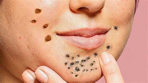 Experts Warn: This Unbelievable Blackhead Removal 2024 Trend is Dangerous! - voysp7k
