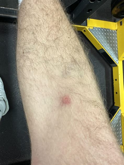 What type of bite is this? Area is numb. : r/Tokyo