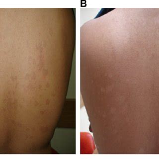 Tinea Versicolor Treatment Before And After