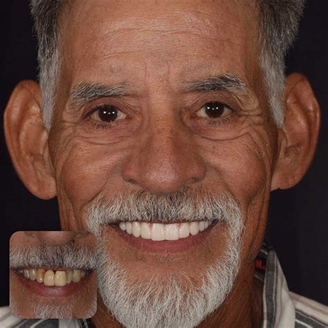 Full Mouth Dental Implants Dallas, TX | Doctors Implants