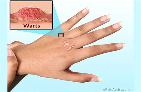 Warts