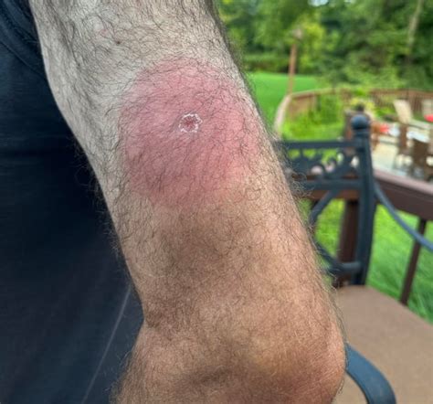 infected bug bite advice needed rmedical