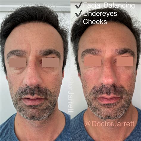 Cheek Fillers - Designer Aesthetics by Dr. Jarrett Schanzer | Miami