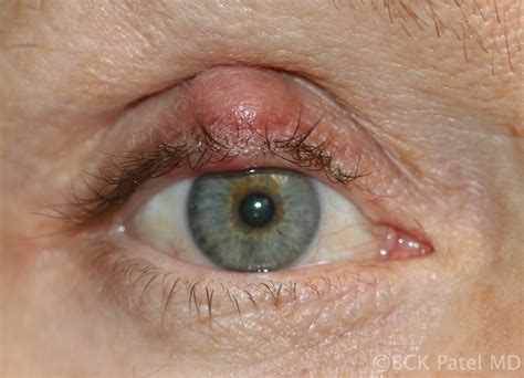 Moran CORE | What are the differences between a stye, a chalazion, an ...
