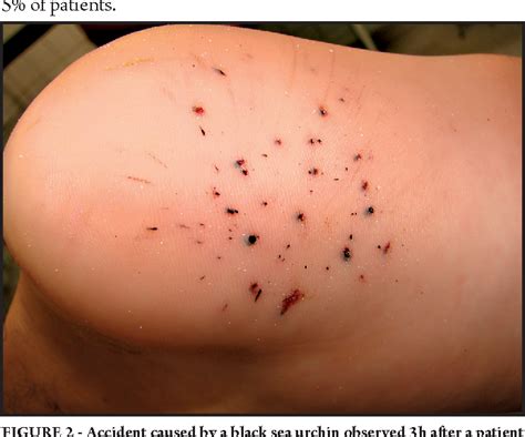 Sea Urchins Sting Effects
