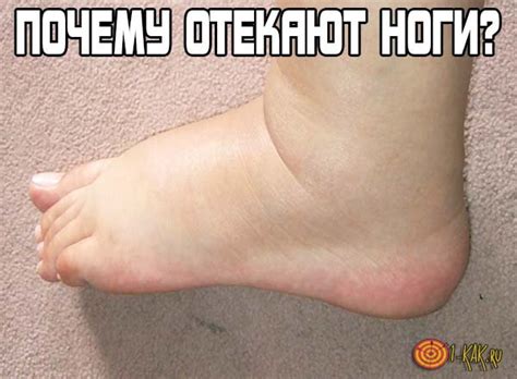 Почему отекают ноги? Что делать, как избавиться от недуга народными ...