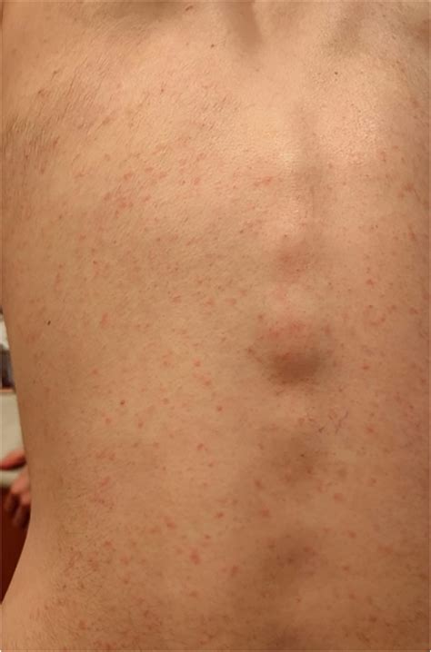 Maculopapular eruptions associated to COVID‐19: A subanalysis of the