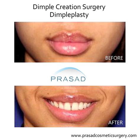 dimple surgery dimple creation learn   york