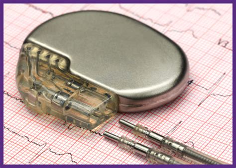 photo   pacemaker  top   ecg chart zaggocare