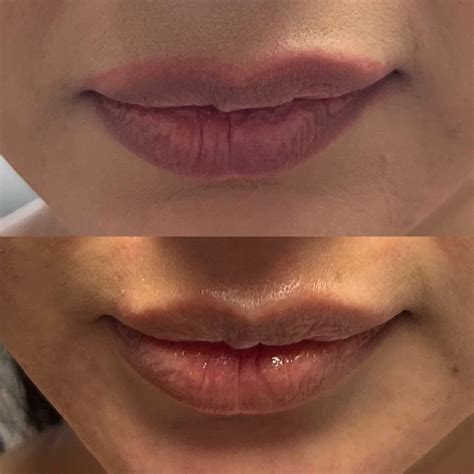 laser surgery  dark lips laser hair removal benefits side