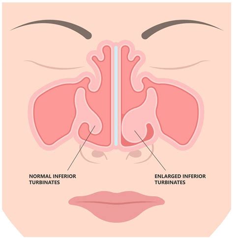 Nasal Anatomy Turbinates