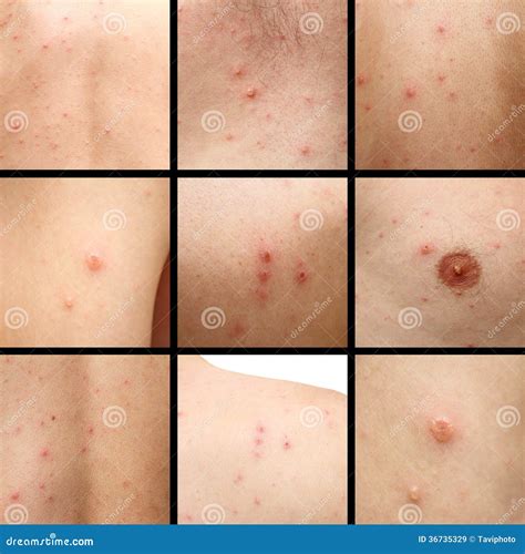 Chicken Pox On Human Skin Royalty-Free Stock Photography