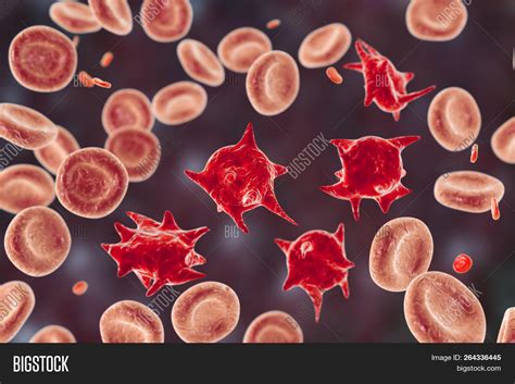 Acanthocytes, Abnormal Image & Photo (Free Trial) | Bigstock