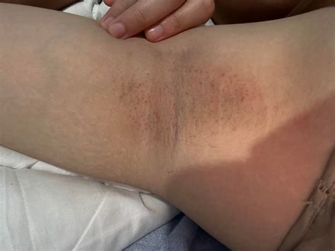 [Routine Help] Help with my underarms : r/SkincareAddiction