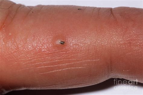 Splinter Photograph by Jane Shemilt/science Photo Library