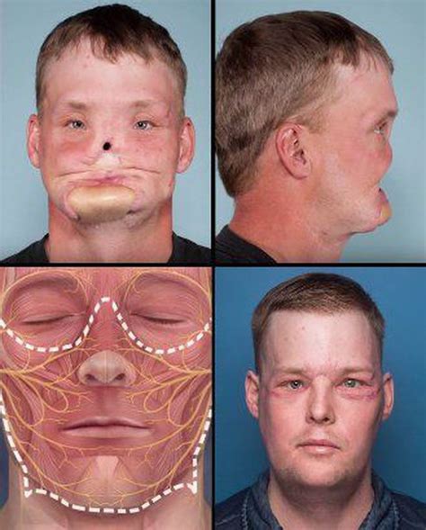 Incredible well performed face transplant : r/pics