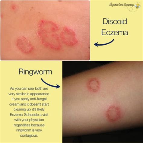 Difference Between Eczema And Ringworm – NBKomputer