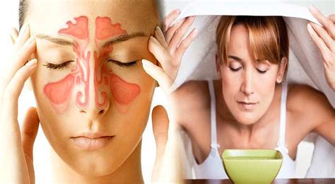 Remedios caseros: Así puedes aliviar la sinusitis con estos trucos ...